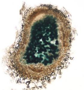 nodule